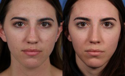 Focus Rinoplastica – Rhinoplasty – chirurgo rinoplastica milano